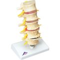 Fabrication Enterprises 3B® Anatomical Model - Vertebrae Degeneration, Stages of Prolapsed Disc 12-4542